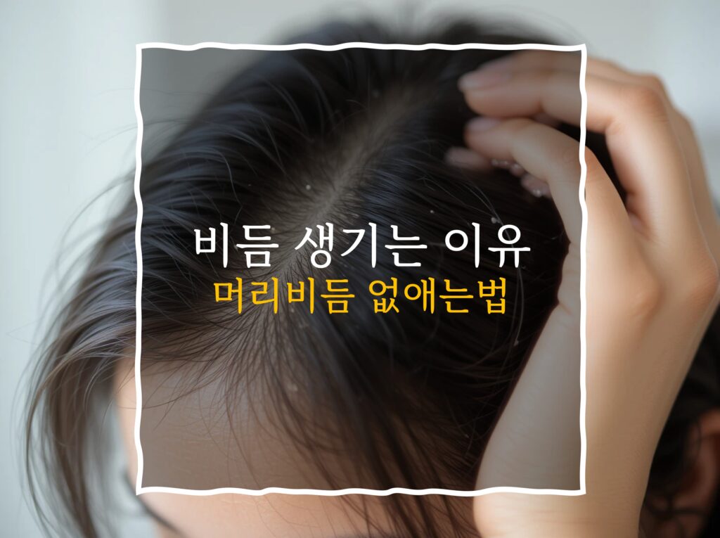 비듬 원인